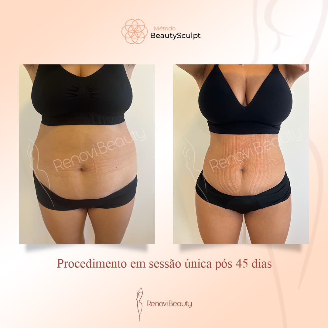 Resultado Excepcional